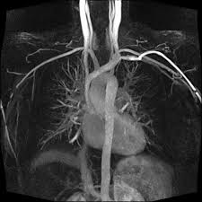 MRI Angiography