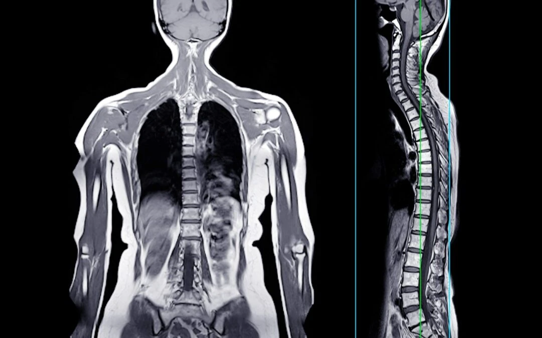MRI Body Scan