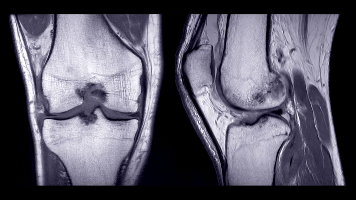 MRI Joint Scan